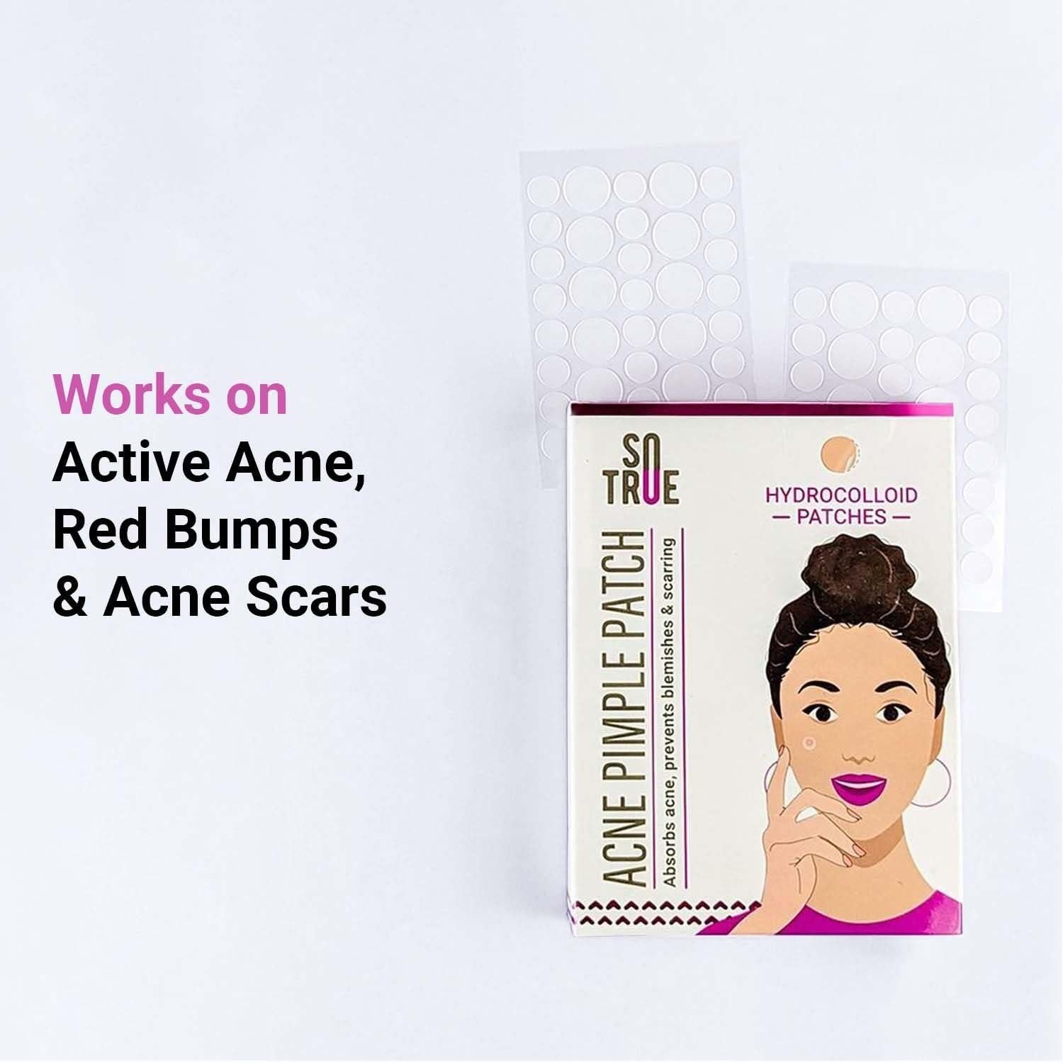 SoTrue Acne Pimple Patches For Face Hydrocolloid Waterproof Patches (36 Patches)